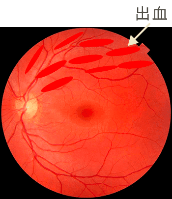 出血
