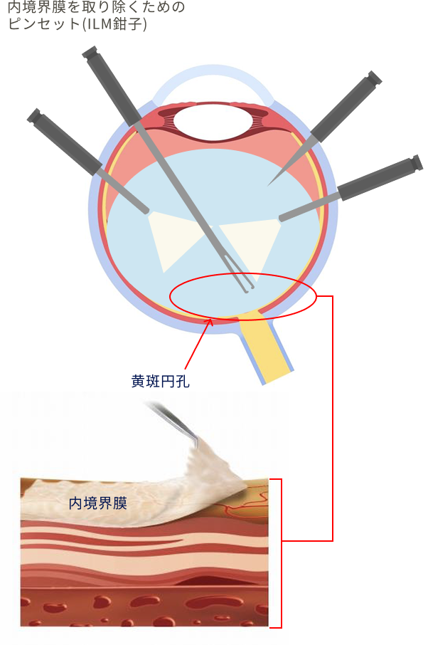 内境界膜を取りのぞく