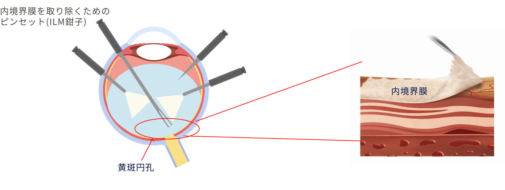 内境界膜を取りのぞく