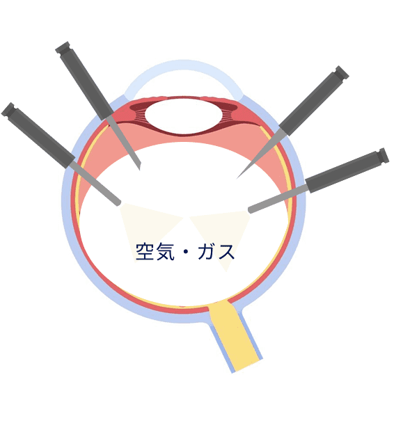空気やガスを入れます。