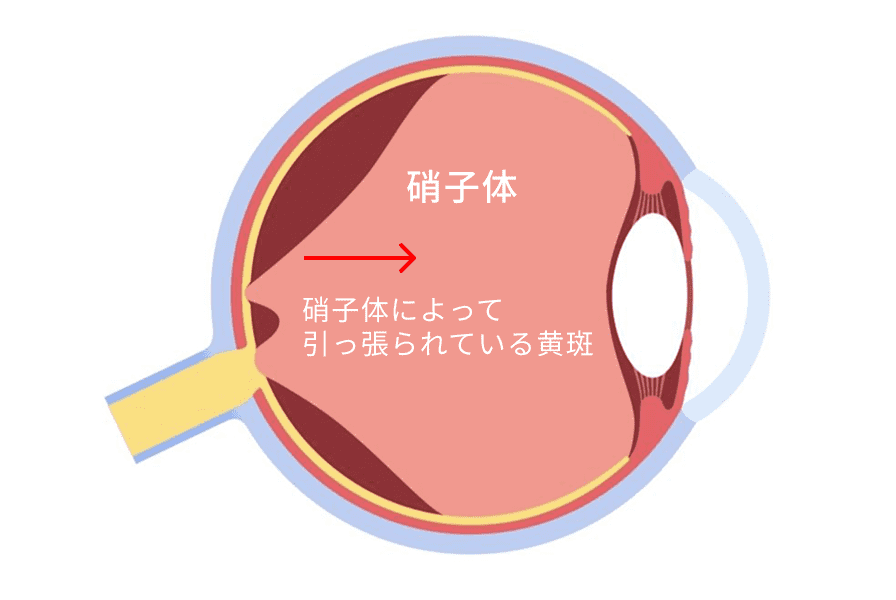 硝子体によって引っ張られている黄斑