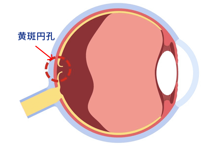 黄斑円孔