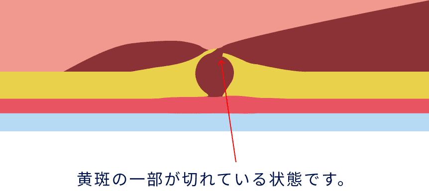 黄斑の一部が切れている状態
