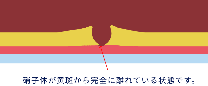 硝子体が黄斑から完全に離れている状態