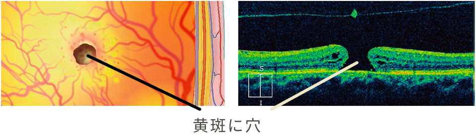 黄斑に穴