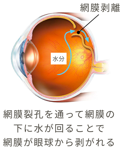網膜裂孔を通って網膜の下に水が回ることで網膜が眼球から剥がれる