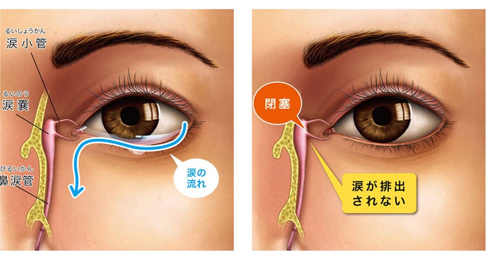 閉塞すると涙が排出されない