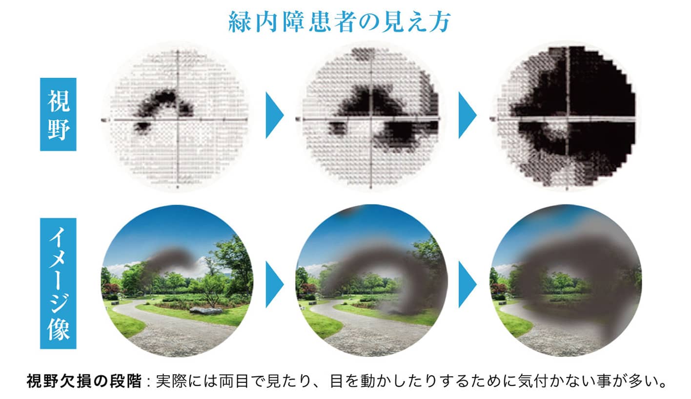 緑内障の患者の見え方