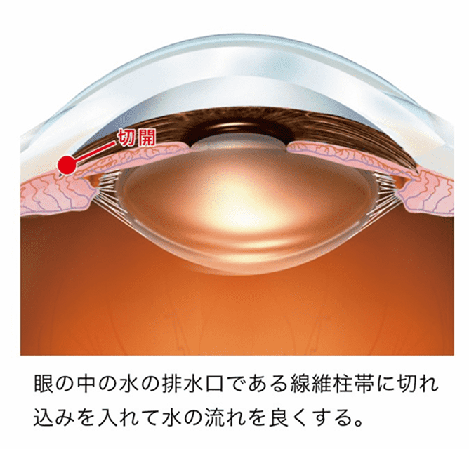 眼の中の水の排水口である繊維柱帯に切れ込みを入れて水の流れをよくする。