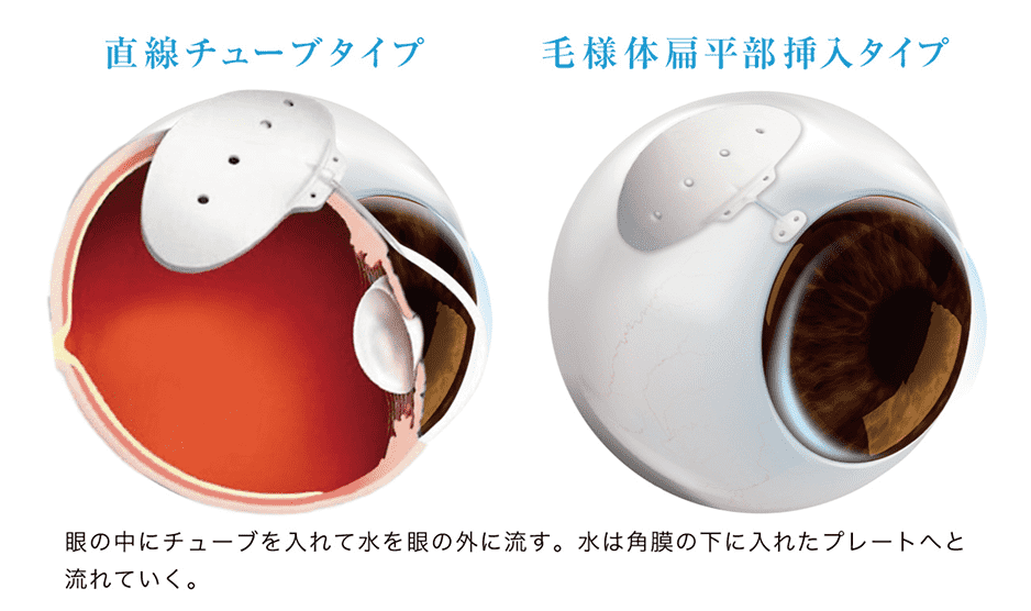 直線チューブタイプと毛様体扁平部挿入タイプ