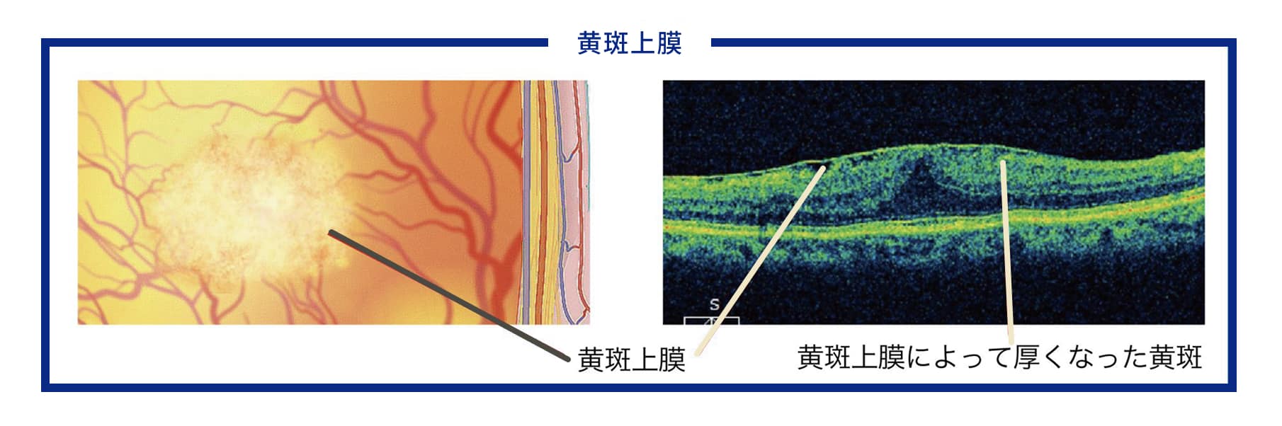 黄斑上膜によって厚くなった黄斑