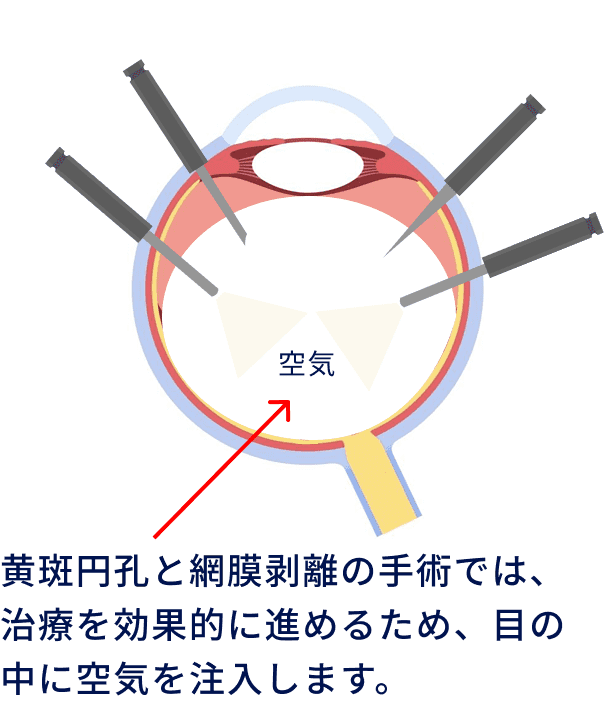 黄斑円孔と網膜剥離の手術では、治療を効果的に進めるため、目の中に空気を注入します
