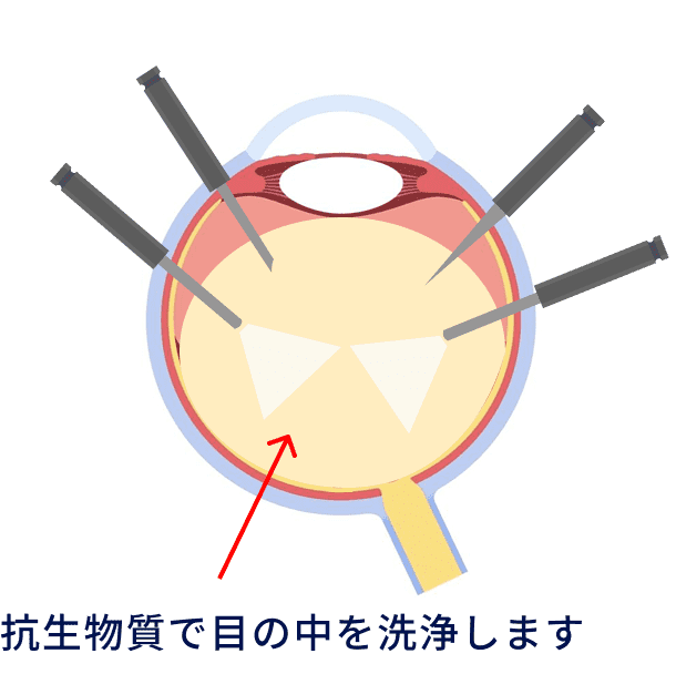 抗生物質で目の中を洗浄します。
