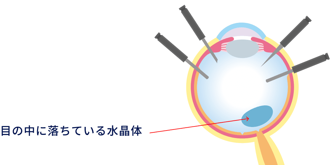 目の中に落ちている水晶体