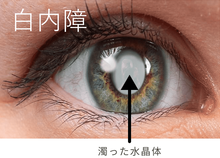 白内障
