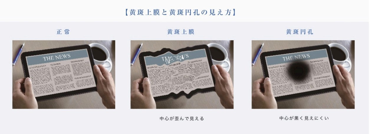 硝子体手術の対象となる主な疾患を示した図