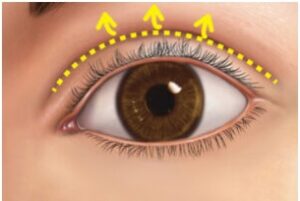 眼瞼下垂の比較図