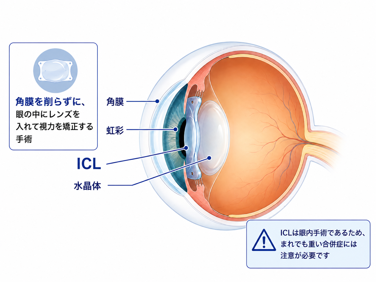 ICLの位置と眼球の構造を示した図
