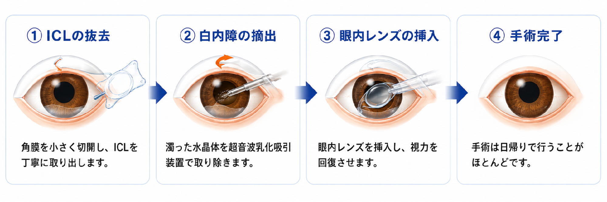 ICL抜去から白内障手術、眼内レンズ挿入までの4つの流れ